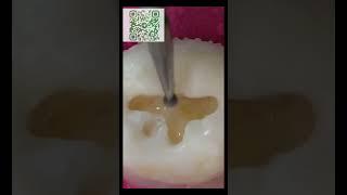 Как лечат кариес,видео от passiondentistry,озвучено мной.ссылка на мой ТГ в профиле