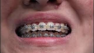 Dental Braces Dubai | Bellaviso Medical Center