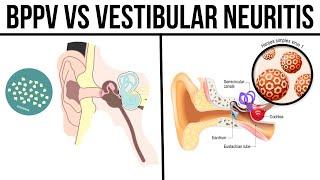 BPPV vs Vestibular Neuritis