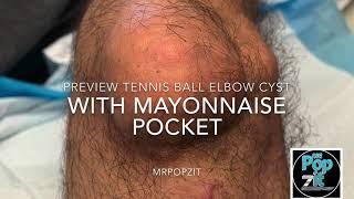 Tennis ball elbow cyst with must see mayonnaise pocket! Hard calcified cyst removal coming soon!!
