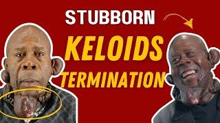 Keloid Warrior's 39 Years Battle with Keloid Bumps:  "I Am Human"