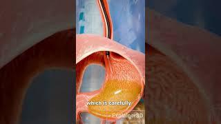 How A Gastric Balloon Works 