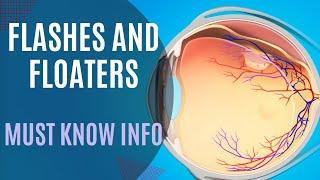 Flashes, Floaters? Posterior Vitreous Detachment vs Retinal Detachment