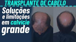 Transplante capilar em calvície grande tem limitações