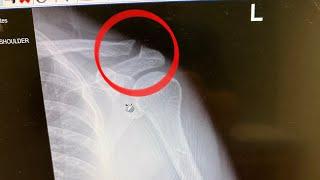 Shoulder Surgery | What your doctor does not tell you to expect