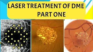 LASER TREATMENT for DIABETIC MACULAR EDEMA - PART 1 focal, grid, modified grid laser and more ..