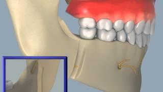 Sagittal Split  Osteotomy