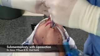 Submentoplasty with Liposuction of Neck  - Surgical Footage