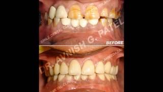 Full mouth rehabilitation follow up upto 4 years.