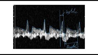 Стилл синдром ультразвуковая характеристика - Still syndrome ultrasound characteristics