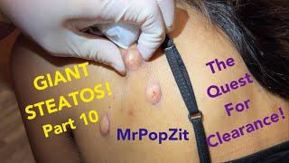 25 minutes of pops! STEATOS, blackheads, cysts extractions! Getting closer to clearance!