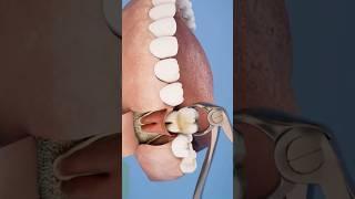 Tooth Extraction 