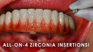 Exciting Techniques for All-On-4 Zirconia Insertions