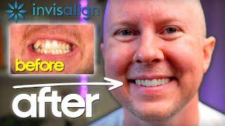 Is Invisalign WORTH It? Honest Review + Before and After Pics