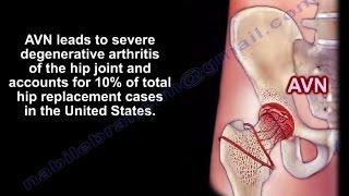 Avascular Necrosis, Osteonecrosis - Everything You Need To Know - Dr. Nabil Ebraheim