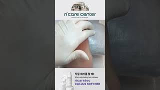 [엔케어센터] 발각질 관리 / 엔케어텍 풋소프트너