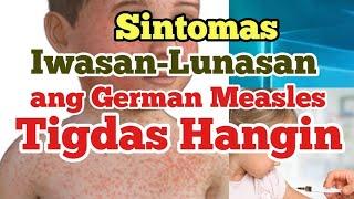 Iwasan - Lunasan ang Tigdas Hangin | Jamestology