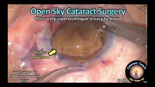 CataractCoach 1469: open sky cataract surgery (corneal transplant)