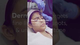 DermaFrac treatment |pigmentation skin treatment | Medifacial | facial at skin clinic delhi