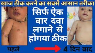 Scabies | खाज क्यू होता हे | बच्चो की खाज की दवाई | Best Treatment for scabies in children in Hindi