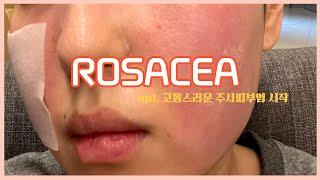 주사피부염 고통의 시작(로사세아)/주사피부염 증상/열감/통증/ROSACEA/힘들었던 시간들