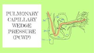Pulmonary capillary wedge pressure (PCWP)