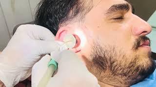 Severe Ear Wax Buildup Removed Safely – Pain, Irritation, and Hearing Damage Reversed!