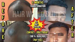 6 மாதத்தில் அடர்த்தியான natural ரிசல்ட் | Chennai, Coimbatore, Tirunelveli | Hair World Clinics