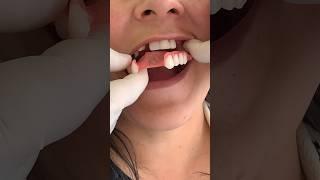 Flexible dental prosthesis, does it work in the mouth? #music #love #travel #viral #dentist #mrdent