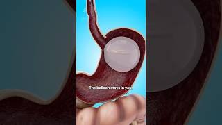 How a Gastric Balloon Helps with Weight Loss  # shorts #viralvideo - Creativelearning3d