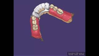 Partial Denture, Crown Bridge, Post and Core