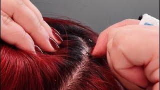 ASMR Scalp Spa: Gentle Dandruff Removal with Fingers (No Talking)