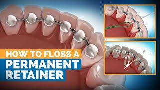 How to Floss a Permanent Retainer | Premier Orthodontics