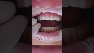 8x Porcelain Veneers! 