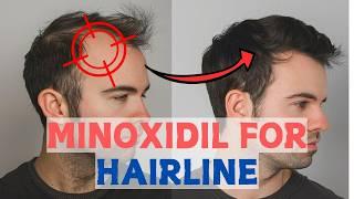 Minoxidil for Frontal Baldness - Restore Your Hairline?