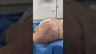 BRAZILIAN BUTT LIFT CRAZY BEFORE AFTER RESULTS | London UK | Centre for Surgery #bbl #360lipo