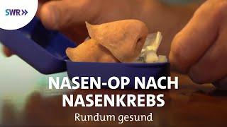 Plastische Operationen nach Nasenkrebs | Rundum gesund