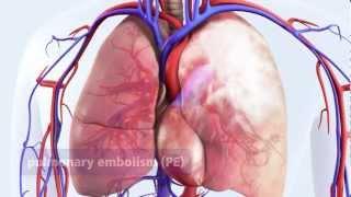 DVT can lead to pulmonary embolism (PE)