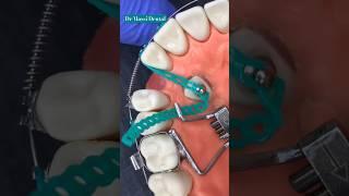 Dental Braces ,Orthodontics brackets