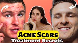 1 Thing That Cleared His Severe Cystic Acne Scarring - Microneedling?! Brian Turner From TeamAcne