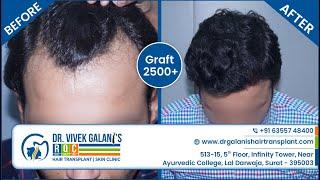 Hair Transplant Clinic In Surat 2021 | Fue - No Root Touch Surgery | Before And After 2500+ Grafts