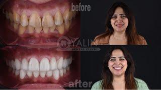 Amazing Change Hollywood Smile Makeover, Best Prices Best Treatments Antalya Turkey