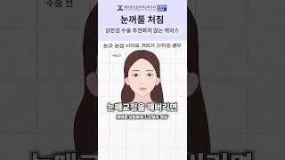 이런 분들은 상안검 수술 비추에요!! #shorts