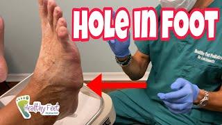 ANOTHER DIABETIC FOOT CATASTROPHE AND BONUS DIABETIC FOOT CARE TIPS