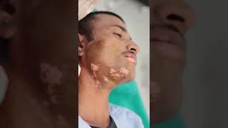 Punch grafting in Vitiligo  : Know step by step procedure | Skinaa Clinic Viral #shorts