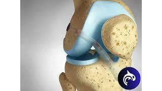 Quick View - ACL PCL Surgical Repair - 3D Animation