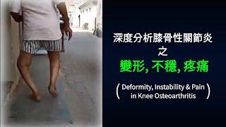 一分鐘醫學 - 深度分析膝骨性關節炎之變形, 不穩, 疼痛 |K39d Deformity, Instability & Pain in Knee Osteoarthritis