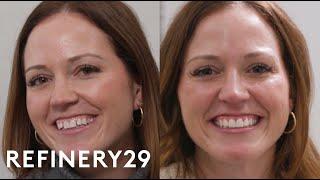 I Got Porcelain Restoration Veneers For The First Time | Macro Beauty | Refinery29