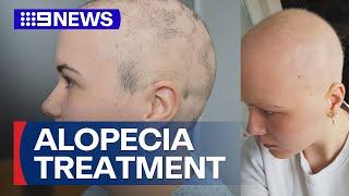 New treatment could help people suffering from alopecia | 9 News Australia