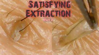 Blackhead + Whiteheads Extraction using tweezer part 2